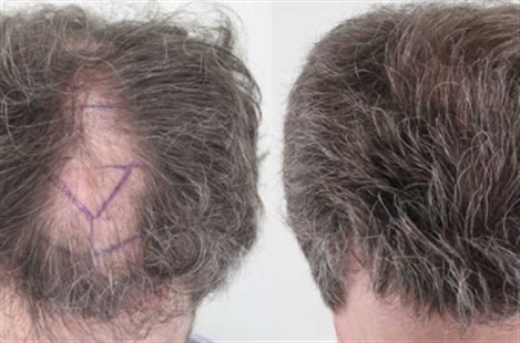 Rahal Hair Transplant