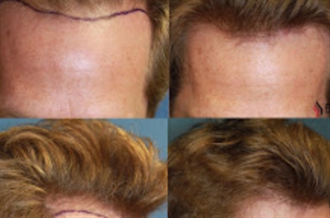 Beverly Hills Hair Restoration