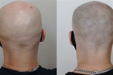 Scalp micropigmentation by Andrey Afanasev in Los Angeles