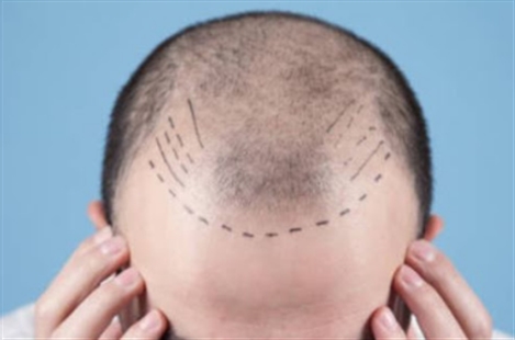 Reference MD - Greffe de cheveux