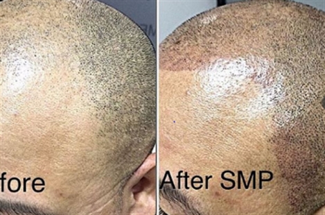 Scalp Micropigmentation Center