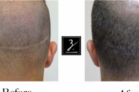 Ziering Medical Hair Restoration Beverly Hills