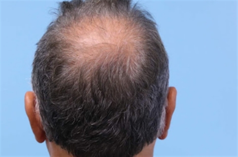 Parsa Mohebi Hair Restoration
