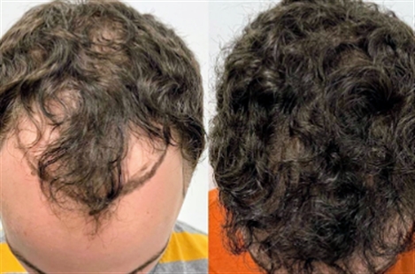 Texas Hair Restoration Center