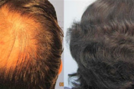Hair Transplant Los Angeles Dr. Sean Behnam
