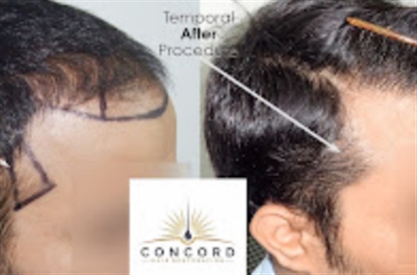 Concord Hair Restoration & Hair Transplant Doctor