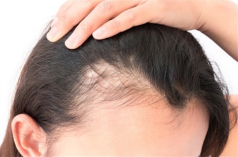 Follicl MD - Hair transplant - Greffe de cheveux