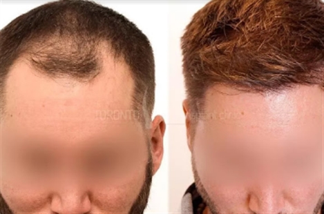 The Toronto Hair Transplant Clinic