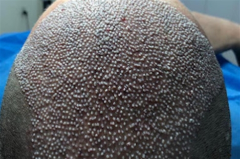 Hair Clinic Frankfurt