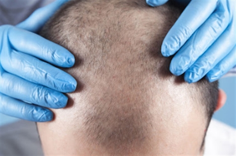 Hair Transplant Medical Centre Toronto