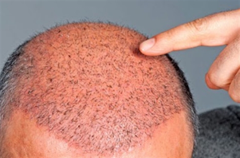 The Hair Loss Recovery Program